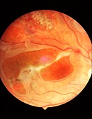 Detached retina in uveitis,fundus image