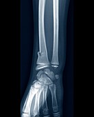 Wrist fracture,X-ray