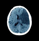 Brain in stroke,CT scan