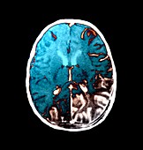 Brain in meningitis,CT scan