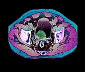 Prostate tumour,CT scan