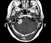 Brain tumour,MRI