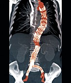 Abdominal aneurysm,CT scan