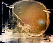 Stereotactic biopsy of brain tumour