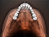 Normal teeth,3D CBCT scan