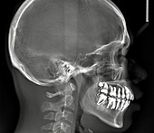 Normal teeth,3D CBCT scan