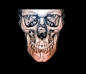 Fractured jaw,3D CT scan