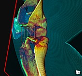 Knee ligament surgery,3D CT scan