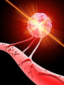 Tumour cell blood vessel,laser treatment