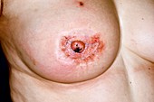 Infected breast cancer surgery wound
