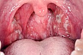 Streptococcal tonsillitis