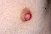 Prominent male nipple