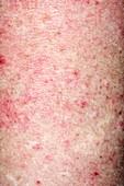 Rash after steroid use