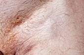 Enlarged lymph glands in self-harm