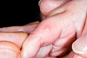 Hand foot and mouth disease