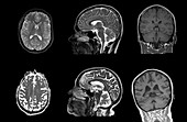 Brain changes with ageing,MRI scans