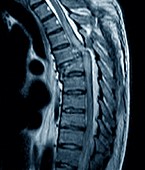 Spinal compression fracture,MRI