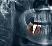 Dental implant,X-ray