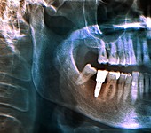 Dental implant,X-ray