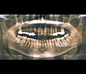 Dental bridge,X-ray