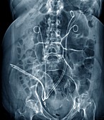 Urinary drains in bladder surgery,X-ray