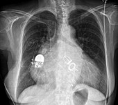 Pacemaker and artificial heart valves