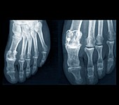 Osteoarthritis of the foot,X-ray
