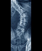 Curvature of the spine,X-ray