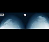 Osteoarthritis of the knees,X-ray