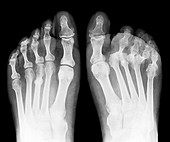 Rheumatoid arthritis of the feet,X-ray