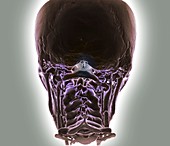 Decreased brain blood flow,3D CT scan