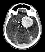Brain tumour,CT scan