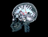 Brain in Alzheimer's disease,MRI