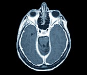 Pachymeningitis,MRI