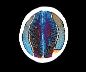 Brain haemorrhage in alcoholism,MRI
