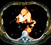 Pulmonary embolism,CT scan