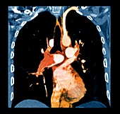 Pulmonary embolism,CT scan