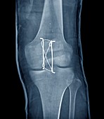 Pinned kneecap fracture,X-ray