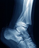 Fractured ankle,X-ray
