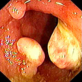 Inflammatory polyps in ulcerative colitis