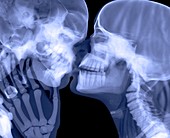 Lovers kissing,X-ray