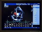 Doppler echocardiography scan
