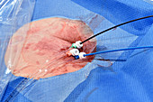 Cardiac ablation surgery catheters