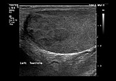 Testicular cancer,ultrasound scan