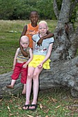 Albino siblings with their black brother