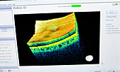 Retinal scan testing for glaucoma