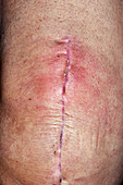 Infected knee replacement surgery wound