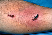 Cellulitis following leg injury