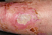 Infected burn