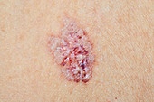 Lichen sclerosus on chest